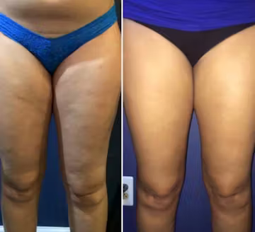 Kollarımda Gözle Görülür Sıkılaşma