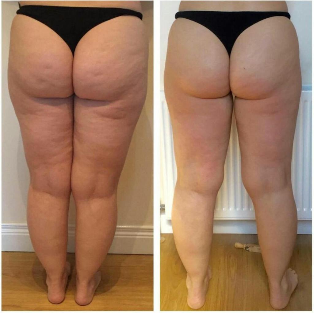 Göbeğimdeki Sarkmalar Toparlandı